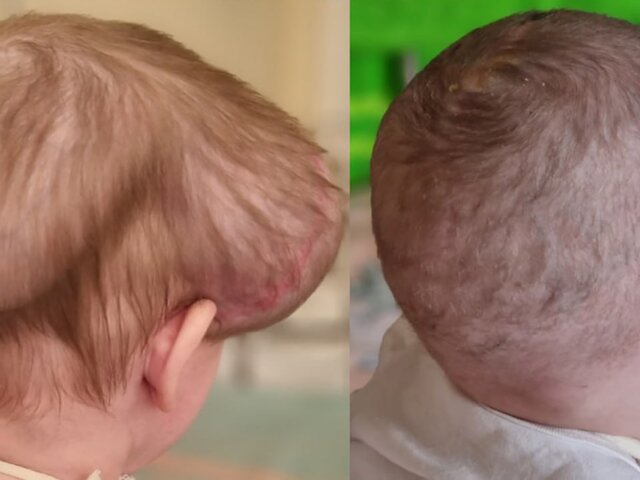 Московские врачи прооперировали двухлетнюю девочку с сильной деформацией головы