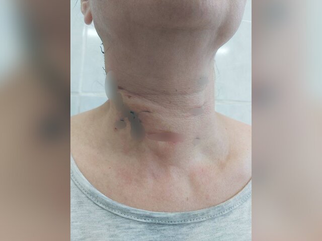 Подмосковные врачи спасли женщину после укуса собаки в шею