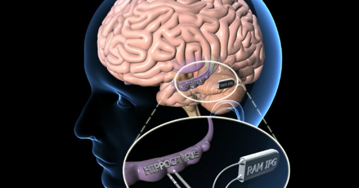 Импланты головного мозга. Мозг память.