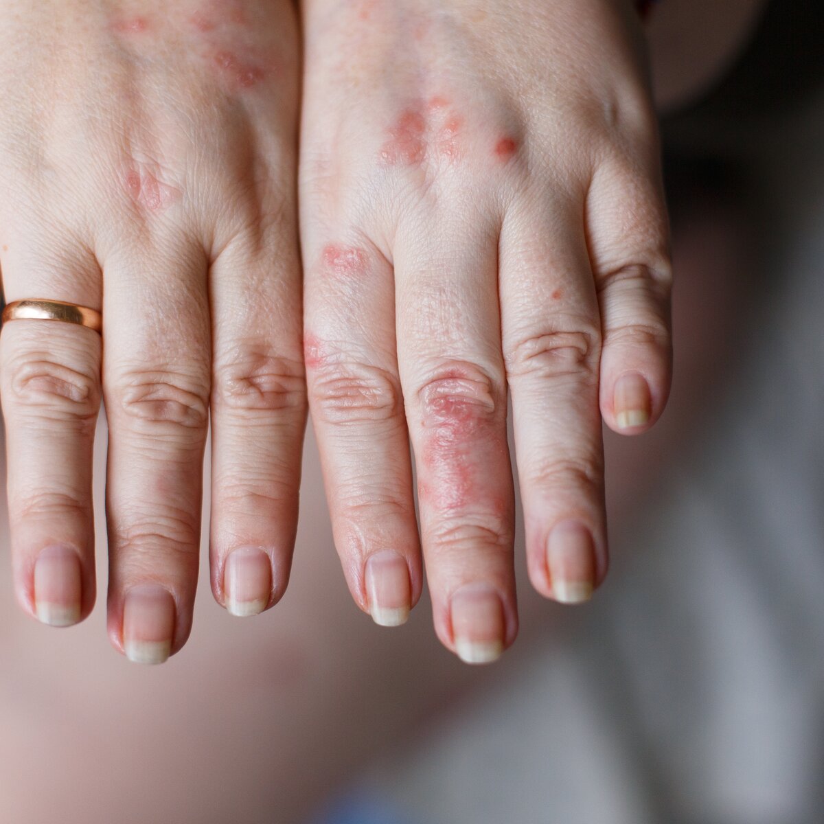 Симптомы аллергии на холод у взрослых: ринит, слезотечение, крапивница