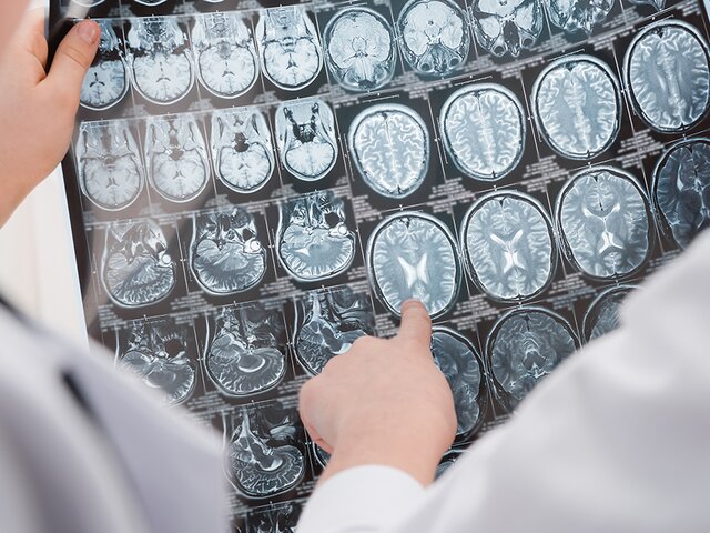 Канадские ученые создали систему, которая оптимизирует нейрочипы для борьбы с эпилепсией