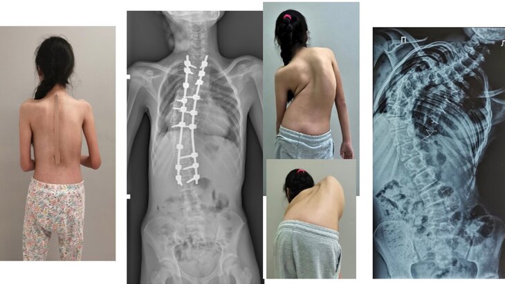 Как можно убрать реберный горб при сколиозе?