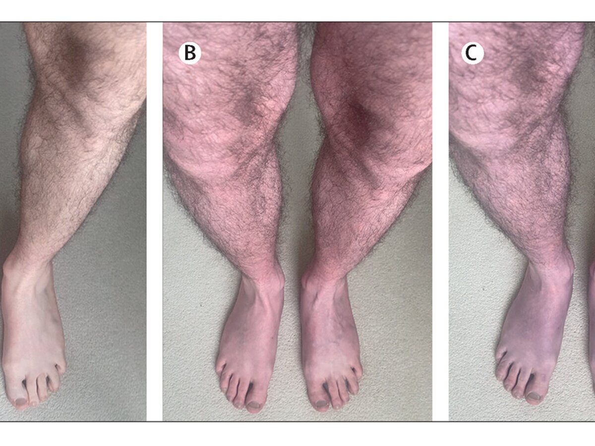 Врач объяснил, почему ноги могут менять цвет после COVID-19 – Москва 24,  14.08.2023